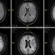 Imagen para el artículo titulado En esta imagen se muestra el devastador efecto que el consumo de la cocaína tiene sobre el cerebro